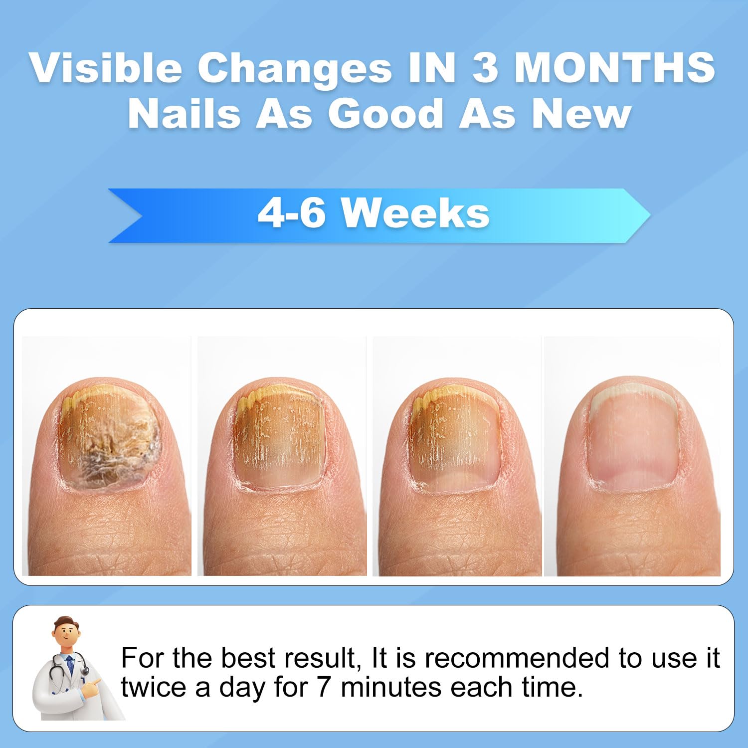 Laser para hongos en las uñas